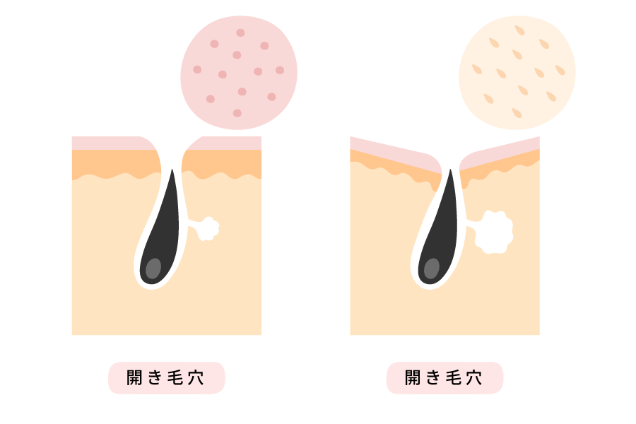 毛穴の図解