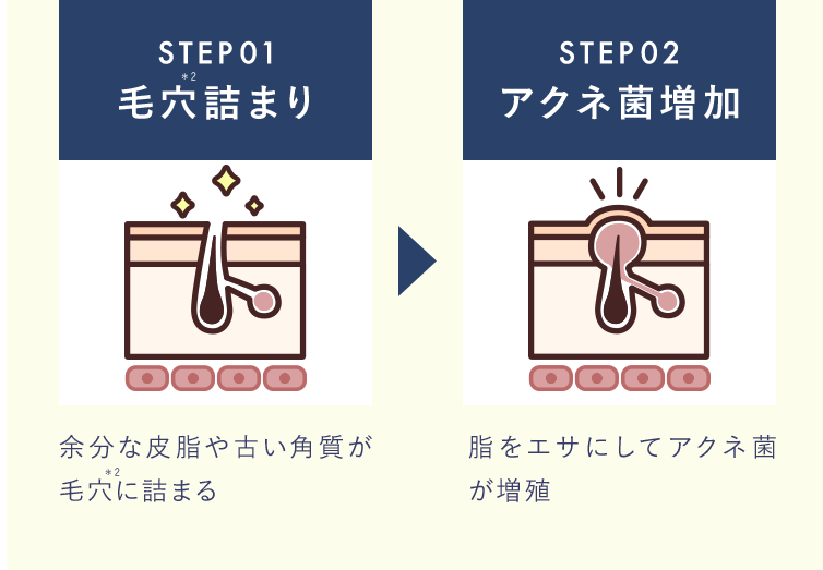 STEP 01 毛穴詰まり 余分な皮脂や古い角質が毛穴に詰まる STEP 02 アクネ菌増加 脂をエサにしてアクネ菌が増殖